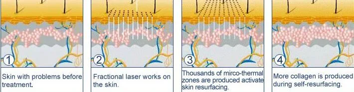 RF CO2 Fractional Laser Face Scar Removal Skin Resurfacing Laser Dermatological Equipment