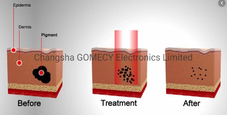 Picolaser Pigmentation Reduction Diamond Laser Carbon Peeling Beauty Machine